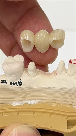 359K views · 549 reactions | Splinted Pontic Bridge! | Luke Kahng | Facebook