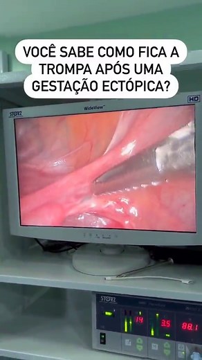 Gravidez Ectópica: Entenda o Processo e a Cirurgia