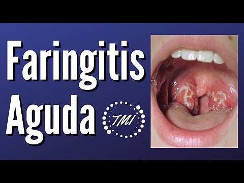 Faringoamigdalitis Aguda | Diagnóstico y Tratamiento