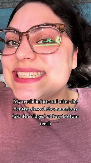 Transforming My Teeth: Before & After Shaving Mamelons
