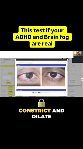 Have you ever seen on TV when a doctor shines a pen light into someone’s eyes to check if they’re okay? That’s not just “eye stuff.” That’s a brain test. 👁️ It’s called the pupillary reflex test. Believe it or not, the speed of how quickly your pupil can constrict, dilate, and hold tells us a lot about how your brain and nervous system are functioning. And sometimes it reveals what spreadsheets can’t: whether your system is overstressed whether your brain is fatiguing too fast whether deeper pa