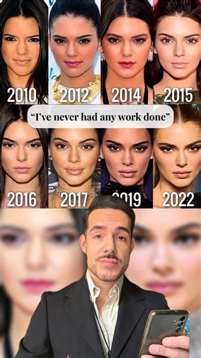 Megaride Aesthetic Clinic | Canada Water - London 📍 on Instagram: "Privacy vs. Transparency: Celeb Edition Kendall Jenner’s recent statements denying the use of plastic surgery have triggered a broader debate, one that extends far beyond her individual appearance. What stands out is the contrast between what is publicly stated and what audiences believe they observe, particularly in an era where images are endlessly re-examined, compared, and closely analysed. Over time, her look has undeniably