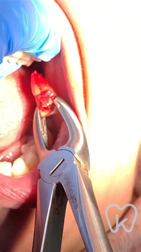 Smooth Upper Wisdom Tooth Removal! #dentist #dentalartistry #dentalprocedure #toothextraction