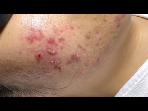 [ASMR] deep cleansing facial blackhead extraction & relaxing skin care