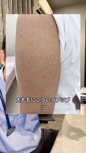 ドクター悠 on Instagram: "腕や足の毛穴のブツブツについて説明！ #医師 #外科医 #ドクター悠 #毛穴 #ブツブツ #スキンケア #毛孔性苔癬 #気になるよね #でもみんなこれなるから #みんなで渡れば怖くないよね #病気というか特徴みたいなもん #そのうち治るさ"