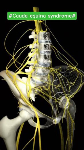 Cauda Equina Syndrome Explained | Symptoms, Causes & Emergency Treatment