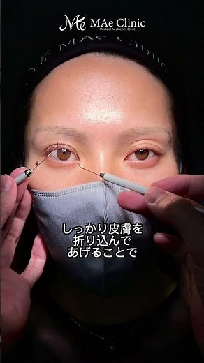 出目の人はまぶたが窪みやすい！？埋没だけで治す方法