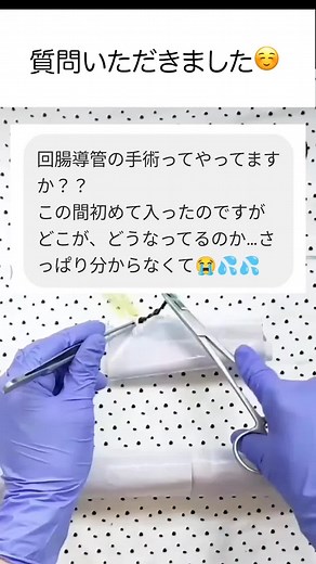 回腸導管についての理解を深める