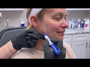 Incredible Instant Thread Lift with VSoft Lifting Threads