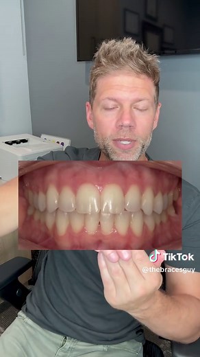 Understanding Normal Overbite: Insights from an Orthodontist