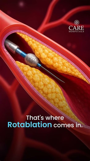 Not Every Blocked Artery Is Caused by Cholesterol. | CARE Hospitals