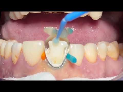 What Expect!😮Professional Teeth Cleaning A Dentist's Step-by-Step #049