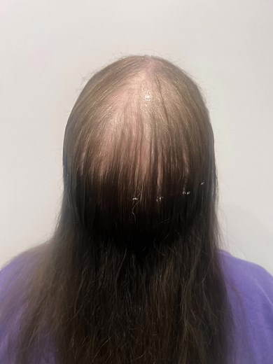 Now she can be like the rest, she feels like she fits in to society, CNC hair transformation by CRLAB LIVERPOOL #hairloss #hairreplacement #hairstyle #alopecia #alopeciaawareness