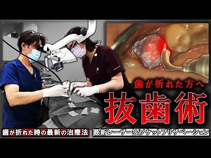 [Latest Tooth Extraction Technique] If your tooth breaks, protect your bone! Socket preservation ...