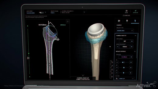 Personalized Reverse Total Shoulder Replacement With the Univers Revers™ Total Shoulder and Virtual Implant Positioning™ Systems