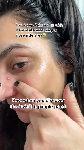 @Tanisha Ahuja i wish i had this pimple patch earlier , have you tried pimple patches to get rid from whitehead acne ??? Let me know ➡️Whenever i get whitehead pimple, i use salyclic acid based serum to reduce the excess oil and sebum production and to reduce acne and to unclog the pores✌🏻 -But now i have also started using pimple patch which works even great and more effective. -This cleared up my whitehead pimple in 2 days. Absolutely Love the result❤️❤️ ✅How to use pimple patch :- ➡️cleanse