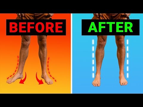 How To Fix Your Turned Out Foot (duck feet) - VERY FAST Results!