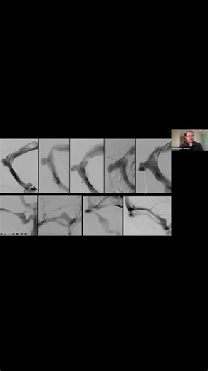 Alicia's Journey with IIH on Instagram: "Educational webinar by @iih_hub exploring the link between pulsatile tinnitus and venous diverticulum in Idiopathic Intracranial Hypertension (IIH), presented by Dr. Mohamad K. Abdalkader, Interventional Neuroradiologist. Views are those of the speaker. Venous sinus stenting discussed is off-label and not FDA-approved. #aliciasjourneywithiih #webinar #iihhub #PulsatileTinnitus #Neuroradiology"