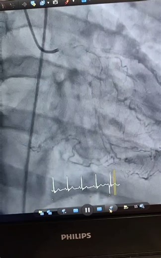 At Akdeniz University, Department of Cardiology, the CX CTO and LAD subtotal occlusion were managed by Prof. Dr. İbrahim Başarıcı and me. Still on the way 💪 | Ersin DOĞANÖZÜ