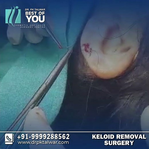 Keloid Removal Surgery Procedure And Results, Keloid Removal Before and After Result by Dr PK Talwar