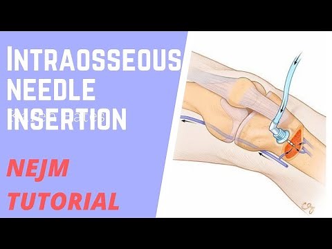NEJM TUTORIAL -Insertion of an Intraosseous Needle in Adults #ClinicalMedicine