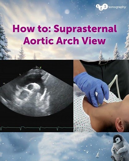 What do you see in this patient's suprasternal notch view?