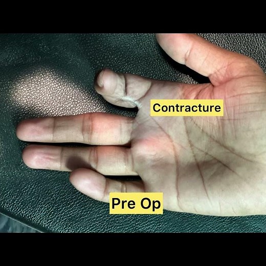 Cross Finger Flap / Post traumatic contracture/ Dr Prayas Kumar ( Plastic Surgeon) / Sudeep Hospital