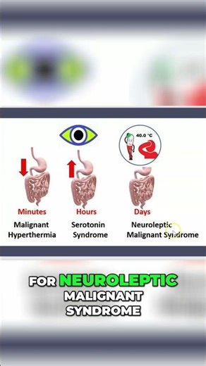 Neuroleptic Magnesian Syndrome NMS & Serotonin Syndrome & Malignant Hyperthermia #shorts
