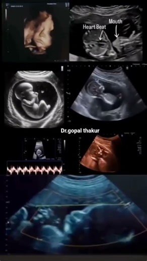 ultrasound scan baby for 9-20 week heart 💜 beat sound
