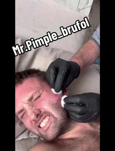 #mrpimplebrufol #brufol #face #facepimples #pimplesface #pimplefacedoncare #facepimplesolution #toppimples #pimplespop #pop #zitspopping #zits #popperpimple #puntosnegros #puntosnegrosencara #pimplesandblackheads #pimplesatisfying #satisfying #pimplesonmyface #facepimpleremove #fypシ #fypシ゚viral #fyp #foryou #you #foryoupage