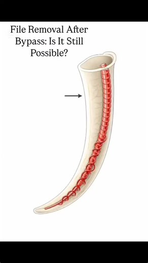 File Removal After Bypass: Is It Still Possible⁉️ 🔴 Outer side of the FILE ➡️ Tensile stress ➡️ Tensile strain (elongation). Inner side of the FILE ➡️ Compressive stress ➡️ Compressive strain (shortening). | Endo.holic