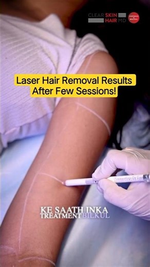 Laser Hair Removal Results After Few Sessions! | Clear Skin Clinic, Pune