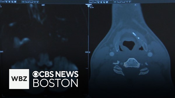 Hospitalizations for cervical artery dissections quadruple over last 15 years, study says