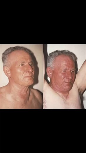 Pemberton's Sign | Superior Vena Cava Obstruction | Cork in the bottle Effect #pemberton #svc #med