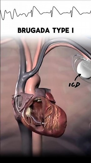 How ICD Saves a Life in Brugada Syndrome | Ventricular Fibrillation Explained