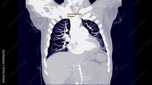 CTA for PE or pulmonary embolism , CT Chest with contrast media agent Coronal MIP View for detect pulmonary embolism. Stock Video