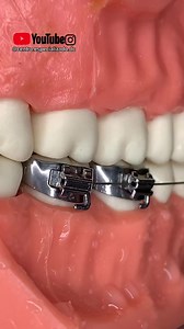 Dr. Diler Cruz #CEDC #dentist #dentistry #dentistryworld #medicine #reelsvideo #reelkarofeelkaro #reels2023 #reelitfeelit #reelschallenge #reelsfacebook #reelsviralシ #reelsusa #fypシ゚ #fypシ゚viralシ | Dr. Diler Cruz