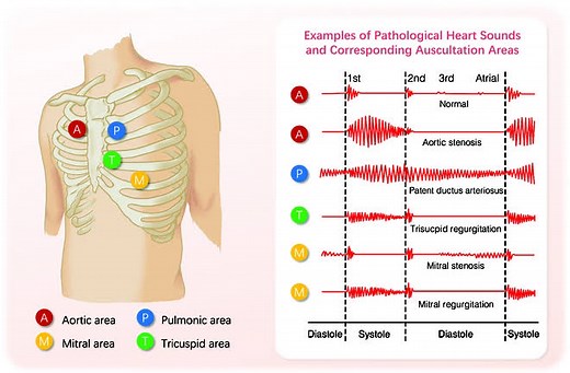 Heart Sounds #medicalstudents #cardiology #heart #doctor #nurse | Doctor X