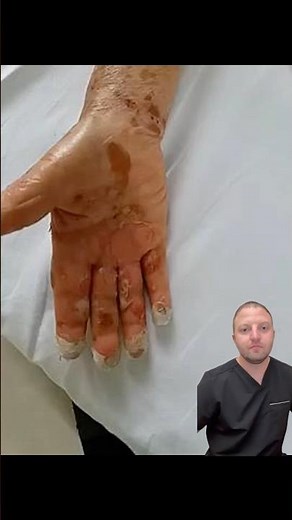 Bullous Pemphigoid. One Skin Condition You Hope You Never Get!