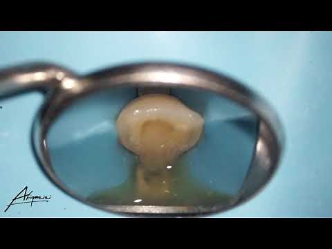 Acute Apical Abscess - Drainage abscess from root canal
