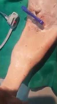 Sirenomelia (Mermaid Syndrome)