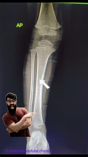 RT. LEG 🦵 FUNDING DESCRIPTION CHECK