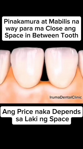 Space Closure using Composite Resin. #irumadentalclinic #priorityyourteeth #oralhealth #tips #spaceclosure #advice #oralcare #dentalcare #dentalhealth #OralHealthMatters #resin #composite #compositebonding | Iruma Dental Clinic