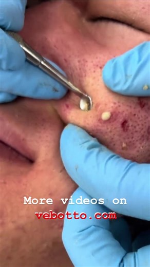 Acne popping #pimple #blackheads #zit #acne #popping