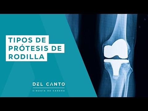 Tipos de Prótesis de Rodilla | DR. DEL CANTO