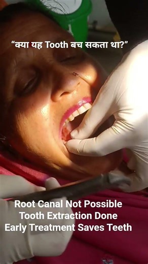 क्या यह Tooth बच सकता था? Late Treatment का Result 😢 PeriapicalAbscess.MolarToothExtraction#dentist