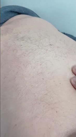 Abdominal Diastasis