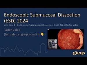 Live Case 1 - Endoscopic Submucosal Dissection (ESD) 2024 (Taster video)