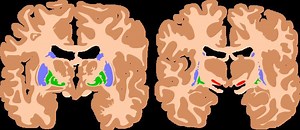 Athetoid cerebral palsy - Alchetron, the free social encyclopedia