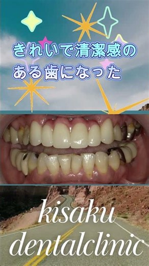 インプラント ビフォーアフター 歯周病で前歯がグラグラ 【Before & After】 #インプラント治療＃きさくデンタル＃歯医者